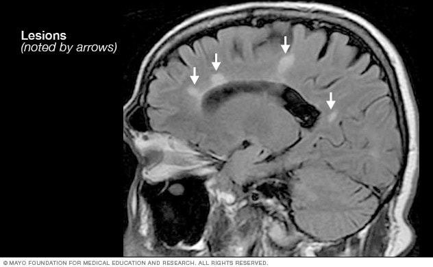 Effective Ways to Test for MS at Home in 2025: Improve Your Understanding