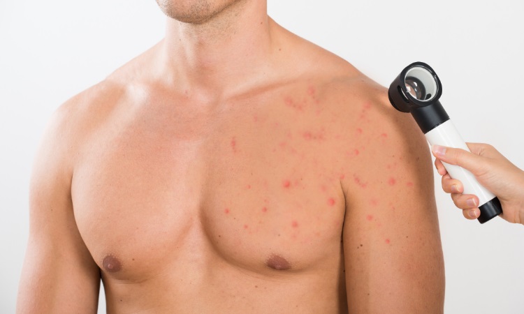 Effective Ways to Get Rid of Chest Acne in 2025: Tips for Clear Skin