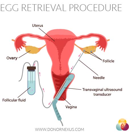 Effective Ways to Donate Eggs in 2025: A Comprehensive Guide to Help Families