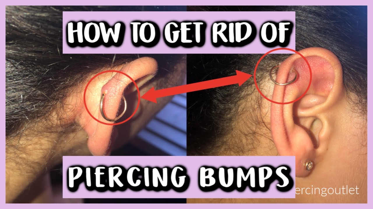 Effective Ways to Remove Piercing Bumps in 2025: Proven Methods to Succeed