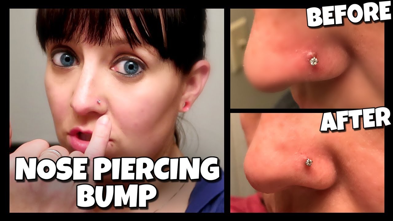 Effective remedies for piercing bumps