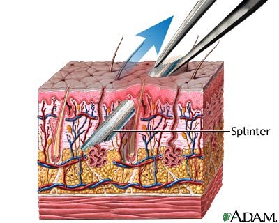 How to Effectively Remove a Splinter: Proven Methods for 2025