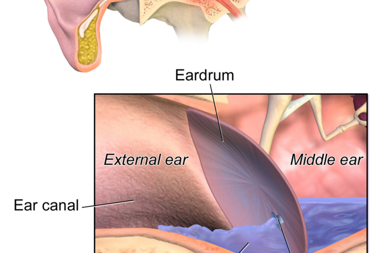 Effective Ways to Get Fluid Out of Your Ear: Practical Tips for 2025