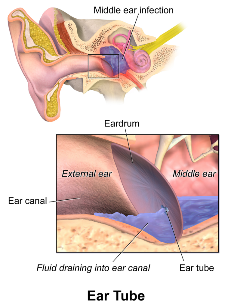 Effective Ways to Get Fluid Out of Your Ear: Practical Tips for 2025