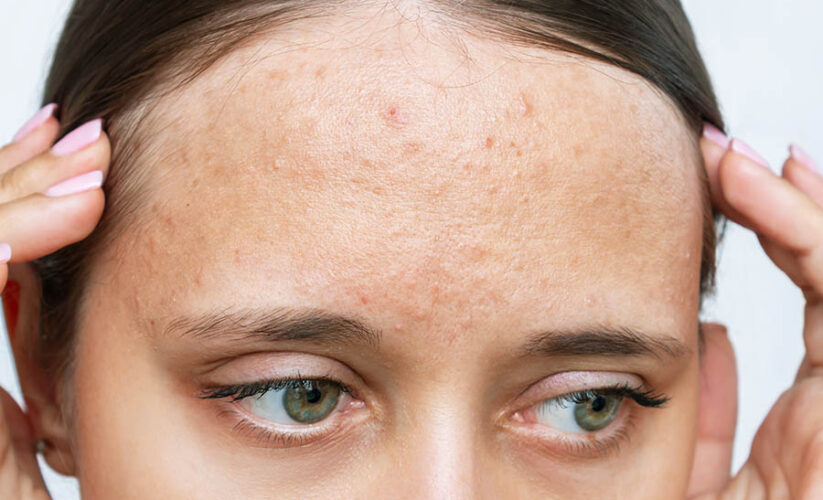 Effective Ways to Get Rid of Forehead Acne in 2025: Discover Practical Solutions!