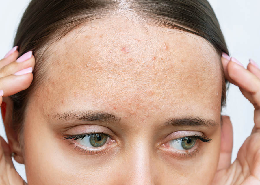 Effective Ways to Get Rid of Forehead Acne in 2025: Discover Practical Solutions!