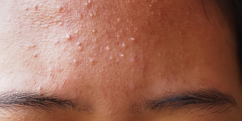 Image showing effective forehead acne treatments