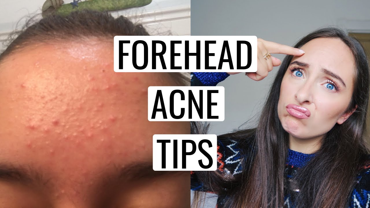 Natural treatments for forehead acne