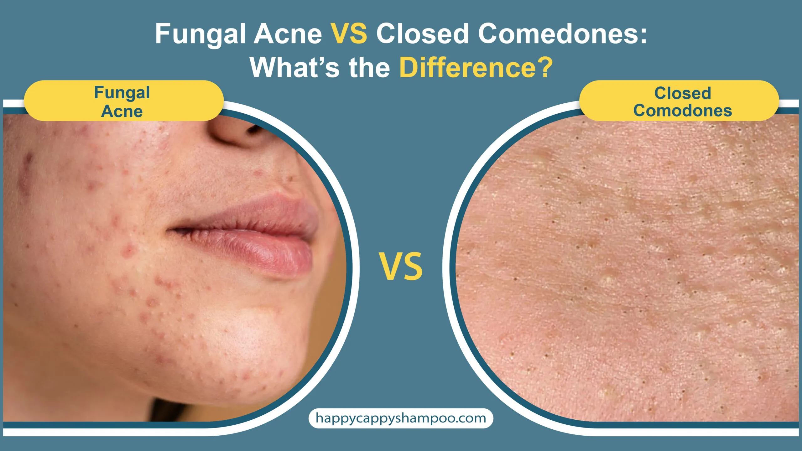 How to Effectively Treat Fungal Acne: Proven Solutions for Clear Skin in 2025